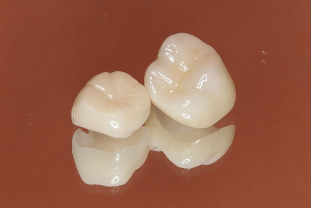 自費の大きい被せ（クラウン）の種類の紹介についてご紹介！