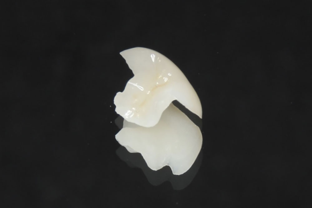 自費診療のインレーの特徴